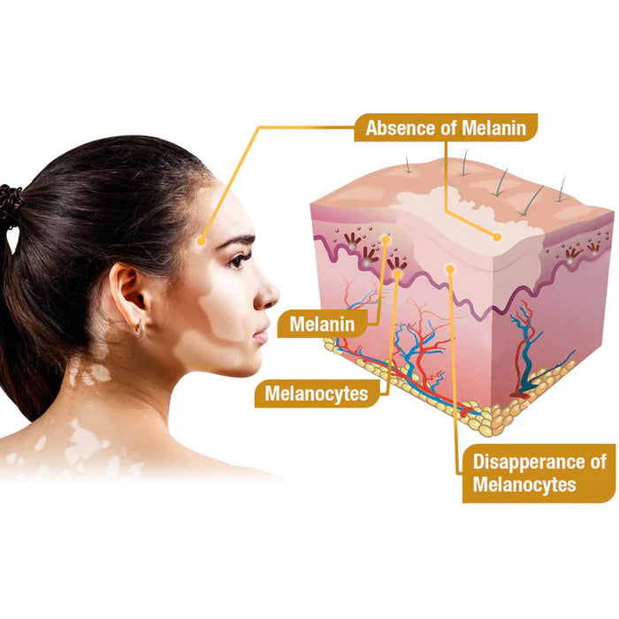 ELITEPRO™ BEE VENOM VITILIGO TREATMENT CREAM