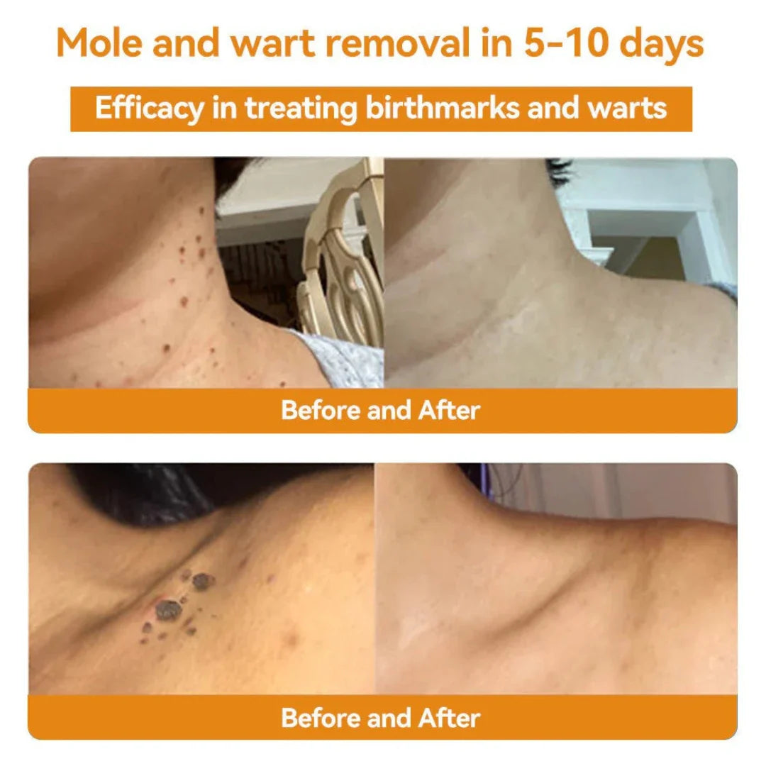 ELITEPRO™ Bee Venom Tag Remover Spray - 30ml : Eliminate Warts & Skin Tags Naturally in Just 1-2 Weeks! 🐝