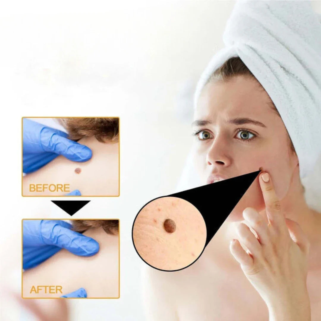 ELITEPRO™ Bee Venom Tag Remover Spray - 30ml : Eliminate Warts & Skin Tags Naturally in Just 1-2 Weeks! 🐝