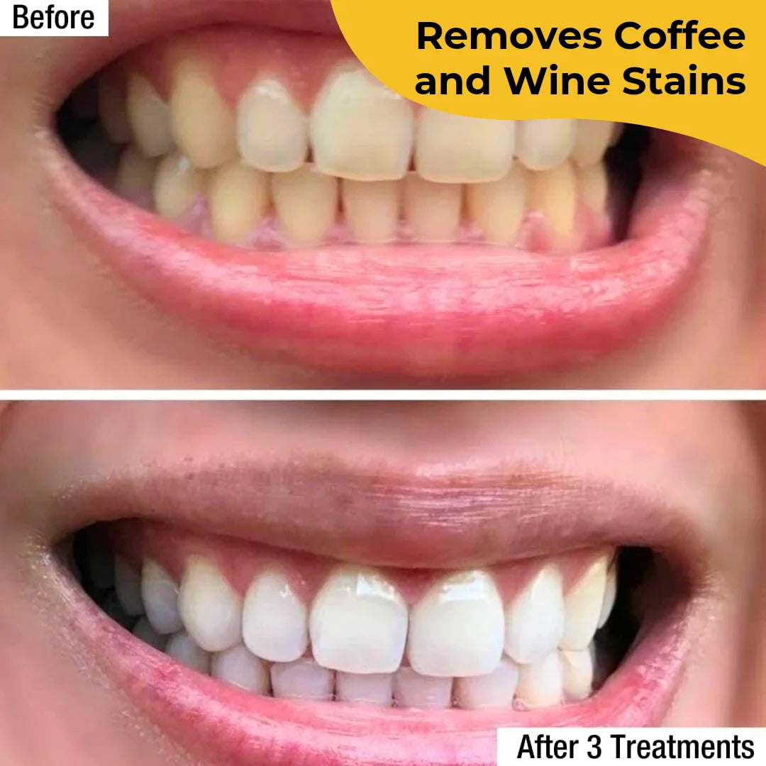 Teeth Whitening Strips