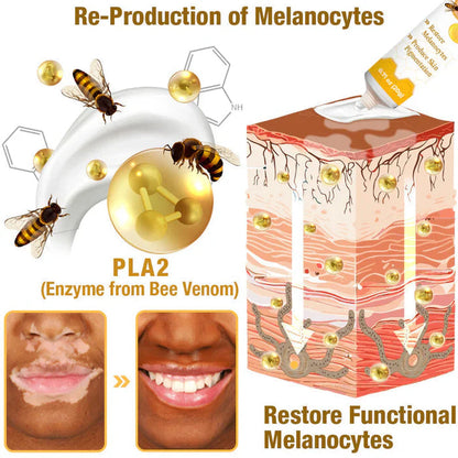 ELITEPRO™ BEE VENOM VITILIGO TREATMENT CREAM