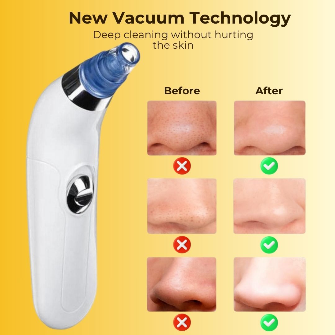 Vacuum Blackhead Remover