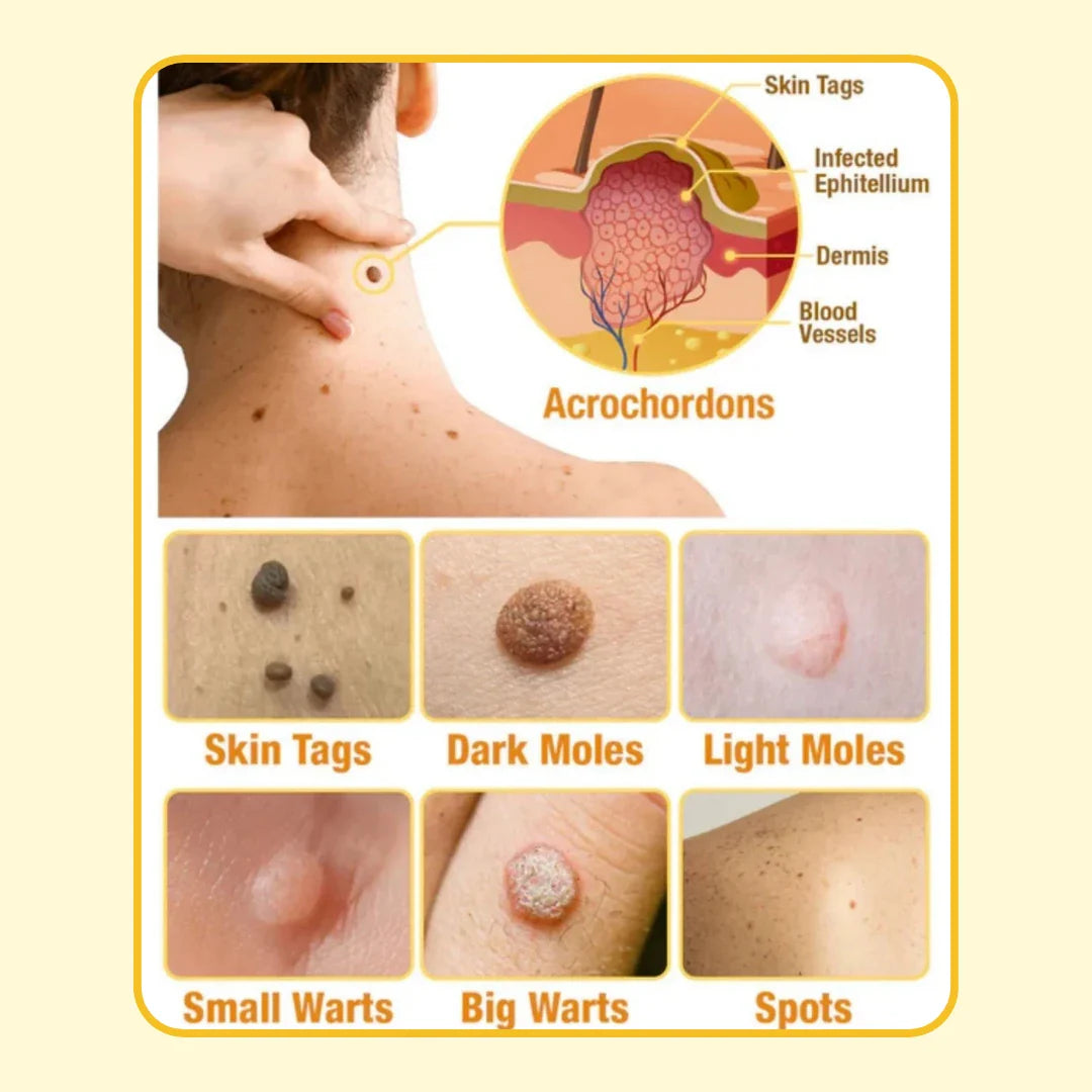 ELITEPRO™ Bee Venom Tag Remover Spray - 30ml : Eliminate Warts & Skin Tags Naturally in Just 1-2 Weeks! 🐝