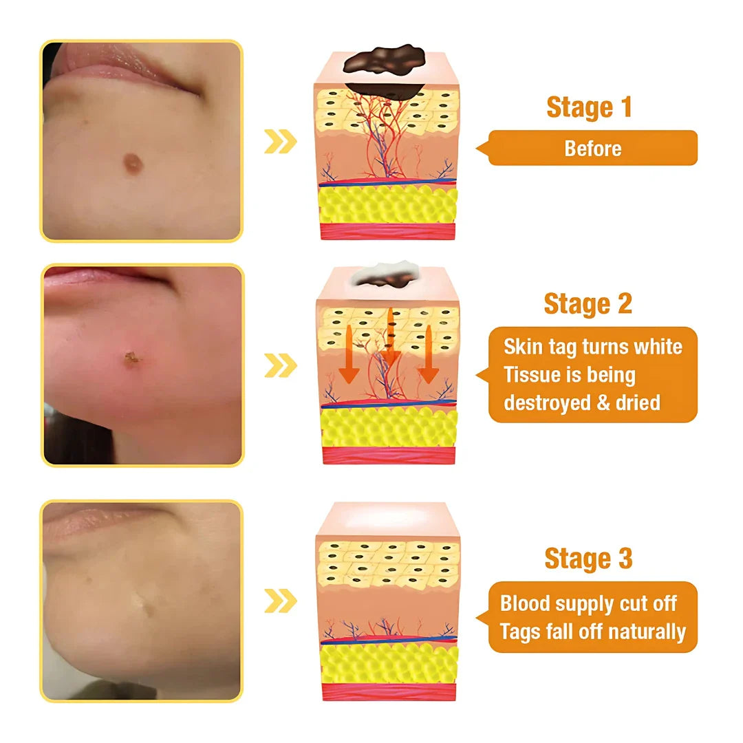 ELITEPRO™ Bee Venom Tag Remover Spray - 30ml : Eliminate Warts & Skin Tags Naturally in Just 1-2 Weeks! 🐝