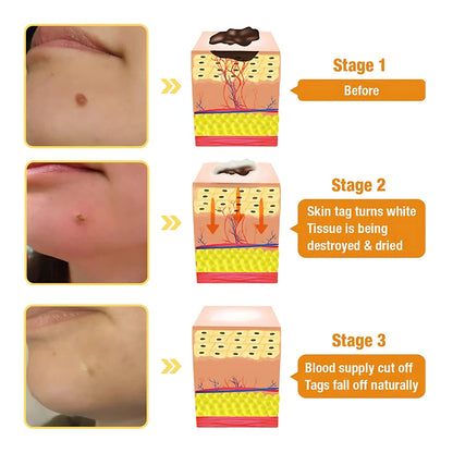 ELITEPRO™ Bee Venom Tag Remover Spray - 30ml : Eliminate Warts & Skin Tags Naturally in Just 1-2 Weeks! 🐝