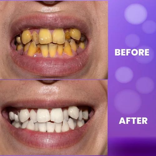 ELITEPRO™ PURPLE TEETH WHITENING GEL